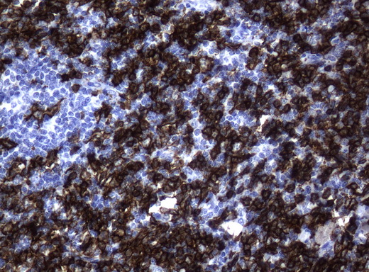 CD20 Antibody - Immunohistochemical staining of paraffin-embedded lymph node tissue using anti-CD20 mouse monoclonal antibody. (Clone UMAB37, Dilution 1:100; heat-induced epitope retrieval by 10mM citric buffer, pH6.0, 120C for 3min)