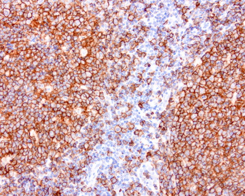 CD20 Antibody - Immunohistochemical staining of paraffin-embedded human tonsil using anti-CD20 mouse monoclonal antibody at 1:200 dilution of 1.0 mg/mL using Polink2 Broad HRP DAB for detection.requires HIER with with citrate pH6.0 at 110C for 3 min using pressure chamber/cooker. The tonsil shows strong membrane and cytoplasmic staining in the germinal center of the tonsil and some poitive cells in the non-germinal center.