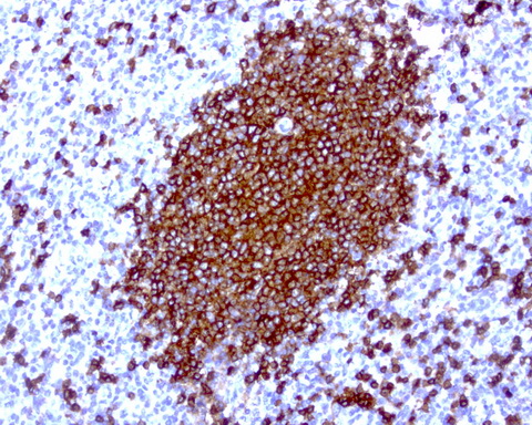 CD20 Antibody - Immunohistochemical staining of paraffin-embedded human spleen using anti-CD20 clone UMAB39 mouse monoclonal antibody at 1:200 dilution of 1mg/mL and detection with Polink2 Broad HRP DAB.requires heat-induced epitope retrieval withCitrate pH6.0 for 3minutes at110C in pressure chamber. The image shows the cells in the white pulp have strong cytoplasmic and membraneous staining.