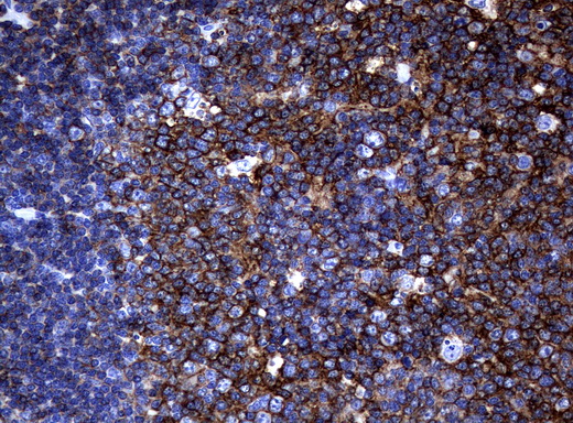 CD20 Antibody - Immunohistochemical staining of paraffin-embedded Human tonsil using anti-MS4A1 mouse monoclonal antibody.  heat-induced epitope retrieval by 10mM citric buffer, pH6.0, 120C for 3min)