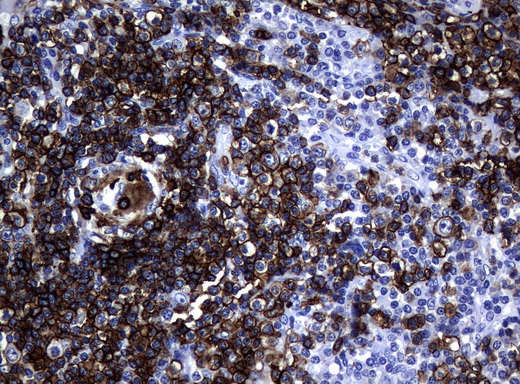 CD20 Antibody - Immunohistochemical staining of paraffin-embedded Human lymphoma tissue using anti-MS4A1 mouse monoclonal antibody.  heat-induced epitope retrieval by 10mM citric buffer, pH6.0, 120C for 3min)