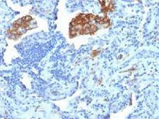 CD209 / DC-SIGN Antibody - IHC testing of FFPE human lung carcinoma with DC-SIGN antibody (clone C209/1781). Required HIER: boil tissue sections in 10mM Tris with 1mM EDTA, pH 9, for 10-20.