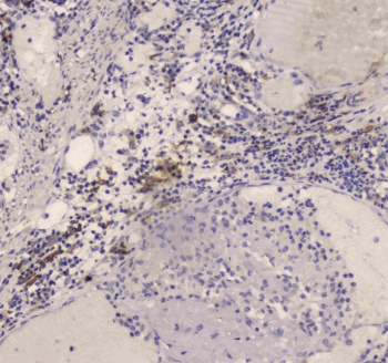CD209 / DC-SIGN Antibody - IHC testing of FFPE human intestinal cancer tissue with DC-SIGN antibody at 1ug/ml. Required HIER: steam section in pH6 citrate buffer for 20 min and allow to cool prior to staining.