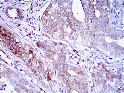 CD22 Antibody - IHC of paraffin-embedded cervical cancer tissues using ZEB1 mouse monoclonal antibody with DAB staining.