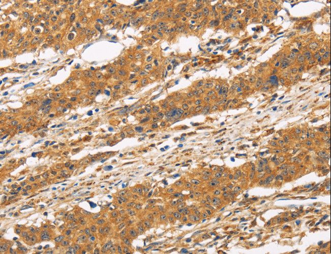 CD22 Antibody - Immunohistochemistry of paraffin-embedded Human thyroid cancer using CD22 Polyclonal Antibody at dilution of 1:50.