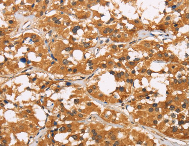 CD22 Antibody - Immunohistochemistry of paraffin-embedded Human thyroid cancer using CD22 Polyclonal Antibody at dilution of 1:50.
