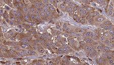 CD225 / IFITM1 Antibody - 1:100 staining human liver carcinoma tissues by IHC-P. The sample was formaldehyde fixed and a heat mediated antigen retrieval step in citrate buffer was performed. The sample was then blocked and incubated with the antibody for 1.5 hours at 22°C. An HRP conjugated goat anti-rabbit antibody was used as the secondary.
