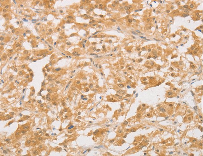CD24 Antibody - Immunohistochemistry of paraffin-embedded Human colon cancer using CD24 Polyclonal Antibody at dilution of 1:40.
