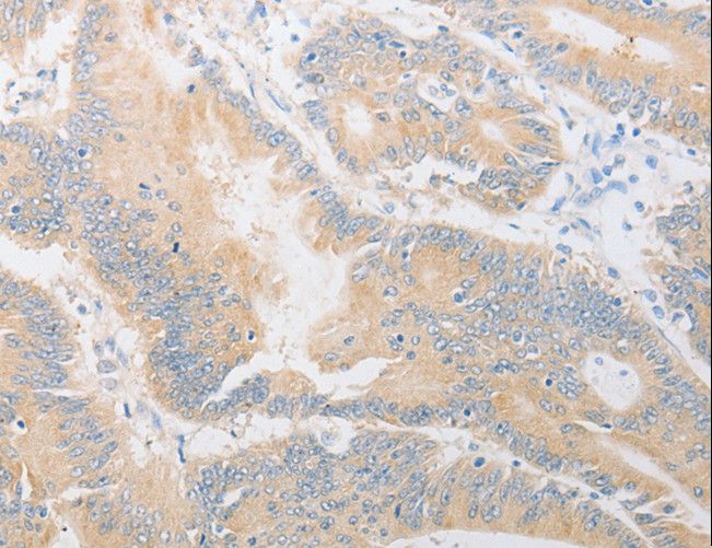 CD24 Antibody - Immunohistochemistry of paraffin-embedded Human colon cancer using CD24 Polyclonal Antibody at dilution of 1:40.