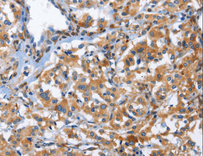 CD244 Antibody - Immunohistochemistry of paraffin-embedded Human thyroid cancer using CD244 Polyclonal Antibody at dilution of 1:50.