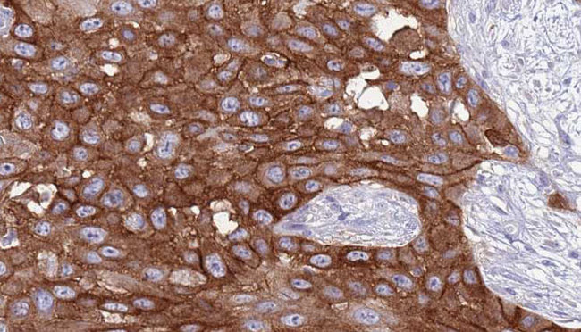 CD247 / CD3 Zeta Antibody - 1:100 staining human Head and neck carcinoma tissue by IHC-P. The sample was formaldehyde fixed and a heat mediated antigen retrieval step in citrate buffer was performed. The sample was then blocked and incubated with the antibody for 1.5 hours at 22°C. An HRP conjugated goat anti-rabbit antibody was used as the secondary.
