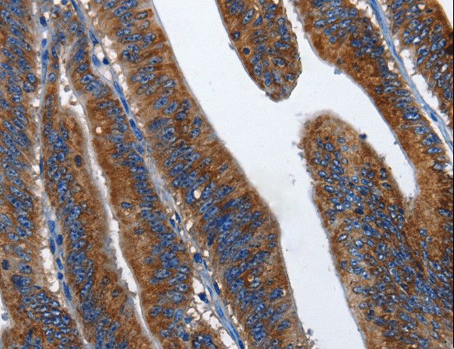 CD27 Antibody - Immunohistochemistry of paraffin-embedded Human colon cancer using CD27 Polyclonal Antibody at dilution of 1:60.