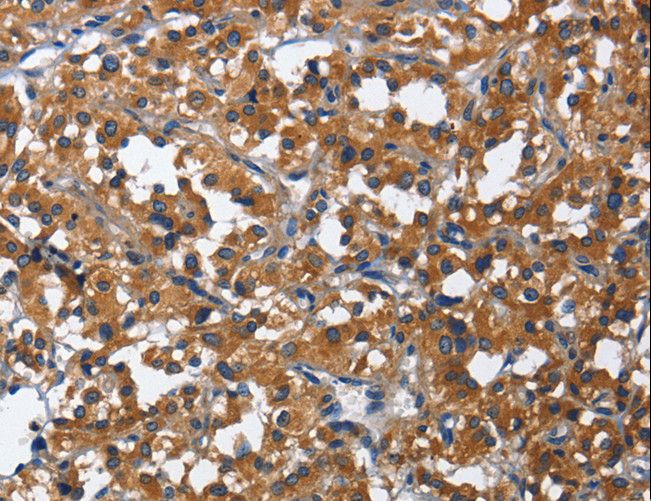 CD27 Antibody - Immunohistochemistry of paraffin-embedded Human thyroid cancer using CD27 Polyclonal Antibody at dilution of 1:60.