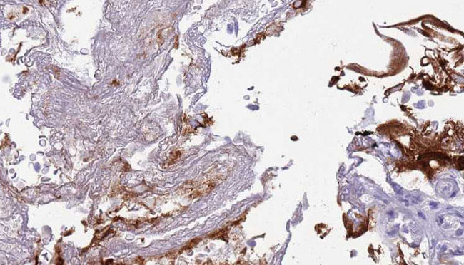 CD27 Antibody - 1:100 staining human urothelial carcinoma tissue by IHC-P. The sample was formaldehyde fixed and a heat mediated antigen retrieval step in citrate buffer was performed. The sample was then blocked and incubated with the antibody for 1.5 hours at 22°C. An HRP conjugated goat anti-rabbit antibody was used as the secondary.