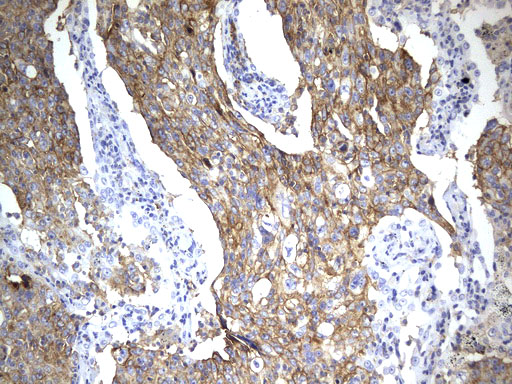 CD274 / B7-H1 / PD-L1 Antibody - Immunohistochemical staining of paraffin-embedded Carcinoma of Human lung tissue using anti-CD274. (PD-L1) mouse monoclonal antibody. (Heat-induced epitope retrieval by 1mM EDTA in 10mM Tris buffer. (pH9.0) at 120°C for 2.5 min. (1:300)