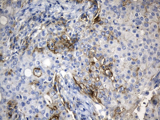 CD274 / B7-H1 / PD-L1 Antibody - Immunohistochemical staining of paraffin-embedded Adenocarcinoma of Human breast tissue tissue using anti-CD274. (PD-L1) mouse monoclonal antibody. (Heat-induced epitope retrieval by 1mM EDTA in 10mM Tris buffer. (pH9.0) at 120°C for 2.5 min. (1:300)