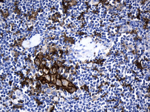 CD274 / B7-H1 / PD-L1 Antibody - Immunohistochemical staining of paraffin-embedded Human lymphoma tissue using anti-CD274. (PD-L1) mouse monoclonal antibody. (Heat-induced epitope retrieval by 1mM EDTA in 10mM Tris buffer. (pH9.0) at 120°C for 2.5 min. (1:300)