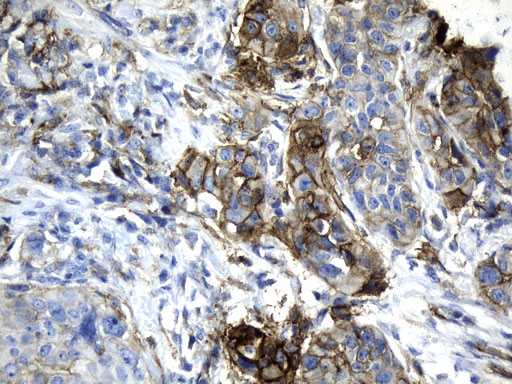 CD274 / B7-H1 / PD-L1 Antibody - Immunohistochemical staining of paraffin-embedded Carcinoma of Human Esophagus using anti-CD274. (PD-L1) mouse monoclonal antibody. (Heat-induced epitope retrieval by 1mM EDTA in 10mM Tris buffer. (pH9.0) at 120°C for 2.5 min. (1:300)
