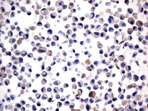 CD274 / B7-H1 / PD-L1 Antibody - Immunohistochemical staining of paraffin-embedded NCI-H2228 cell pellets using anti-CD274. (PD-L1) mouse monoclonal antibody. (Heat-induced epitope retrieval by 1mM EDTA in 10mM Tris buffer. (pH9.0) at 120°C for 2.5 min. (1:300)