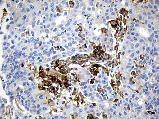 CD274 / B7-H1 / PD-L1 Antibody - Immunohistochemical staining of paraffin-embedded Carcinoma of Human liver tissue using anti-CD274. (PD-L1) mouse monoclonal antibody. (Heat-induced epitope retrieval by 1mM EDTA in 10mM Tris buffer. (pH9.0) at 120°C for 2.5 min. (1:300)