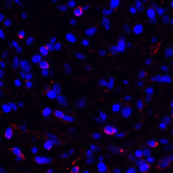 CD274 / B7-H1 / PD-L1 Antibody - Immunofluorescence of PD-L1 in human stomach carcinoma tissue with PD-L1 antibody at 2 ug/mL. Red: PDL1 Antibody [1F11] Blue: DAPI staining