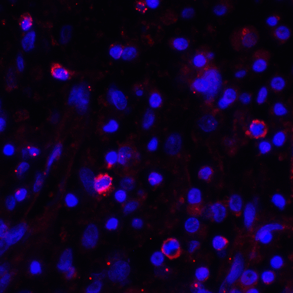 CD274 / B7-H1 / PD-L1 Antibody - Immunofluorescence of PD-L1 in human stomach carcinoma tissue with PD-L1 antibody at 2 ug/mL. Red: PDL1 Antibody [2D6] Blue: DAPI staining
