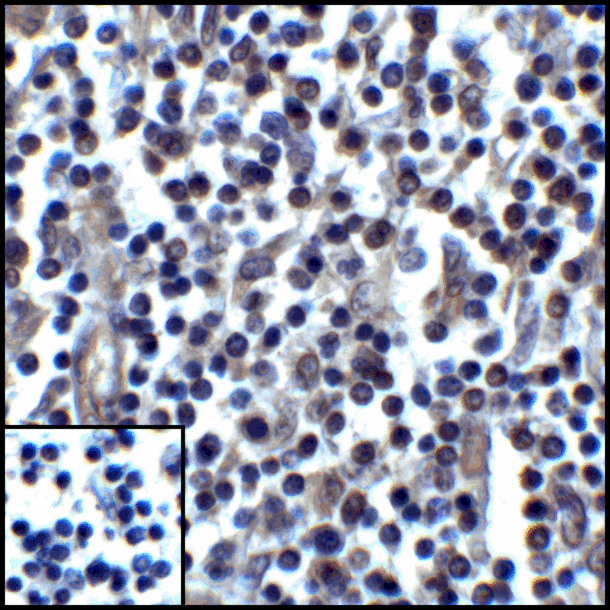 CD274 / B7-H1 / PD-L1 Antibody - Immunohistochemistry of PD-L1 in human stomach carcinoma tissue with PD-L1 antibody at 5 ug/mL.
