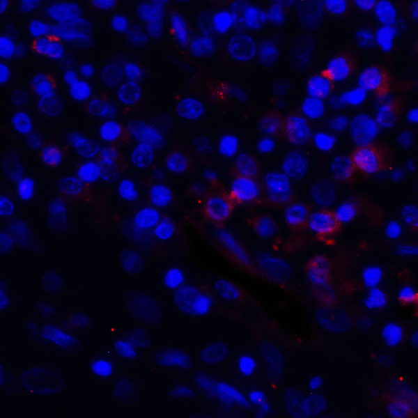 CD274 / B7-H1 / PD-L1 Antibody - Immunofluorescence of PD-L1 in human stomach carcinoma tissue with PD-L1 antibody at 2 ug/mL. Red: PDL1 Antibody [4F2] Blue: DAPI staining