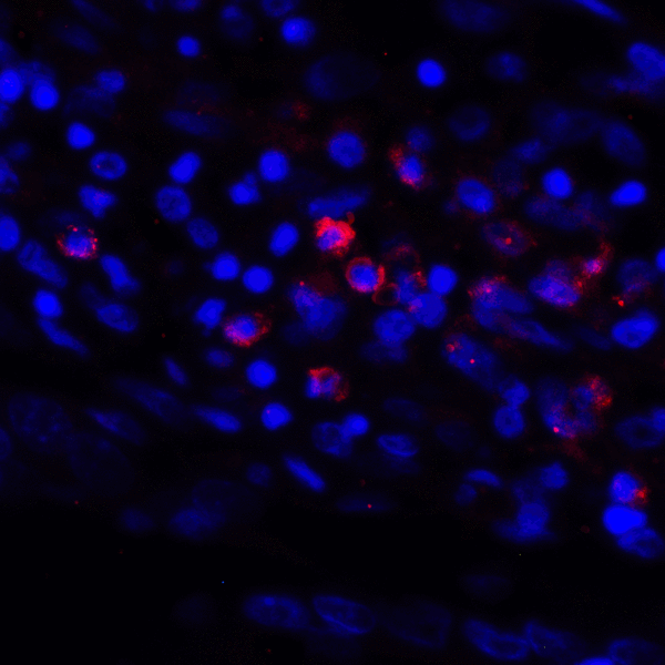 CD274 / B7-H1 / PD-L1 Antibody - Immunofluorescence of PD-L1 in human stomach carcinoma tissue with PD-L1 antibody at 2 ug/mL. Red: PDL1 Antibody [6H10] Blue: DAPI staining