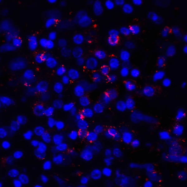 CD274 / B7-H1 / PD-L1 Antibody - Immunofluorescence of PD-L1 in human stomach carcinoma tissue with PD-L1 antibody at 2 ug/mL. Red: PDL1 Antibody [8E12] Blue: DAPI staining
