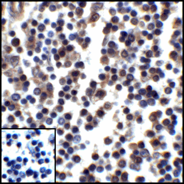 CD274 / B7-H1 / PD-L1 Antibody - Immunohistochemistry of PD-L1 in human stomach carcinoma tissue with PD-L1 antibody at 5 ug/mL.