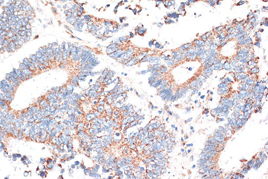 CD274 / B7-H1 / PD-L1 Antibody - Immunohistochemistry of paraffin-embedded human colon carcinoma using CD274 Antibody at dilution of 1:100 (40x lens).