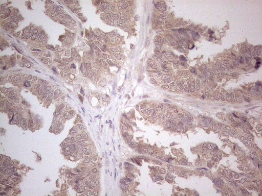 CD275 / B7-H2 / ICOS Ligand Antibody - Immunohistochemical staining of paraffin-embedded Adenocarcinoma of Human ovary tissue using anti-ICOSLG mouse monoclonal antibody. (Heat-induced epitope retrieval by 1mM EDTA in 10mM Tris buffer. (pH8.5) at 120°C for 3 min. (1:150)