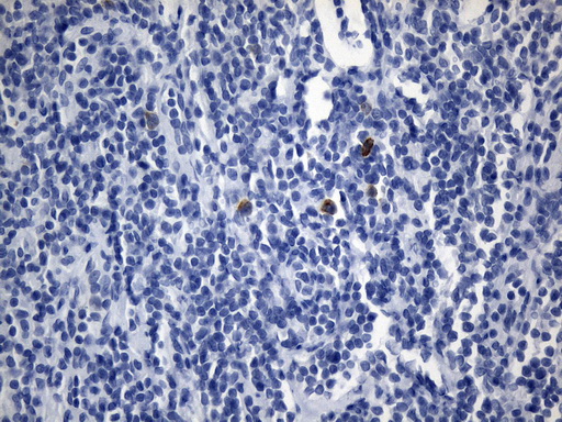 CD275 / B7-H2 / ICOS Ligand Antibody - Immunohistochemical staining of paraffin-embedded Human lymphoma tissue using anti-ICOSLG. (B7H2, CD275) mouse monoclonal antibody. (Heat-induced epitope retrieval by 1mM EDTA in 10mM Tris buffer. (pH8.0) at 120°C for 2.5 min. (1:300)