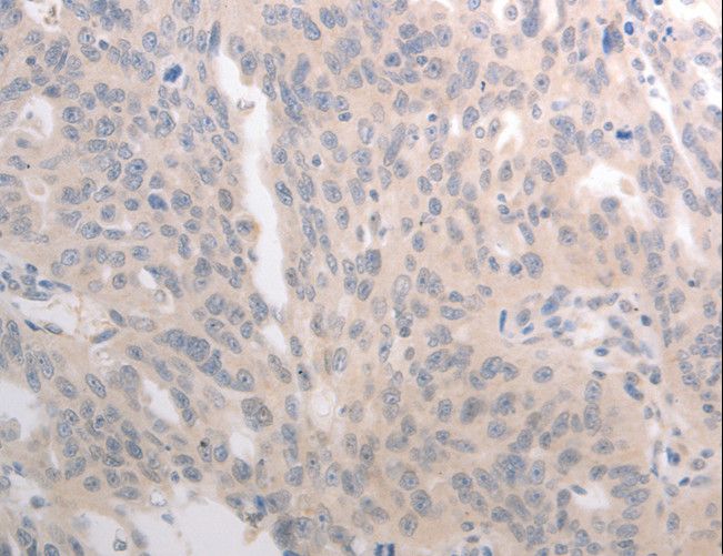 CD275 / B7-H2 / ICOS Ligand Antibody - Immunohistochemistry of paraffin-embedded Human ovarian cancer using ICOSLG Polyclonal Antibody at dilution of 1:30.