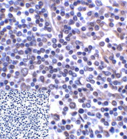 CD276 / B7-H3 Antibody - Immunohistochemistry of B7-H3 in human colon carcinoma tissue using B7-H3 Antibody and control mouse IgG (corner box) at 2 ug/ml.