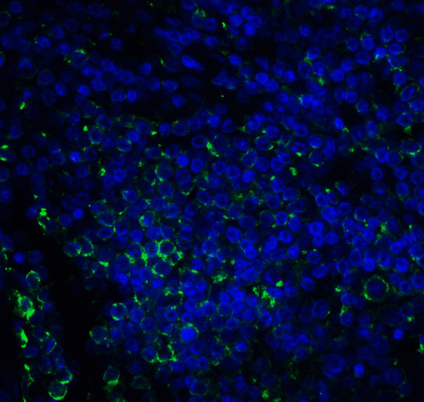 CD276 / B7-H3 Antibody - Immunofluorescence of B7-H3 in human colon carcinoma tissue cells using B7-H3 Antibody at 10 ug/ml. Green: B7-H3 Antibody [2A7] Blue: DAPI staining