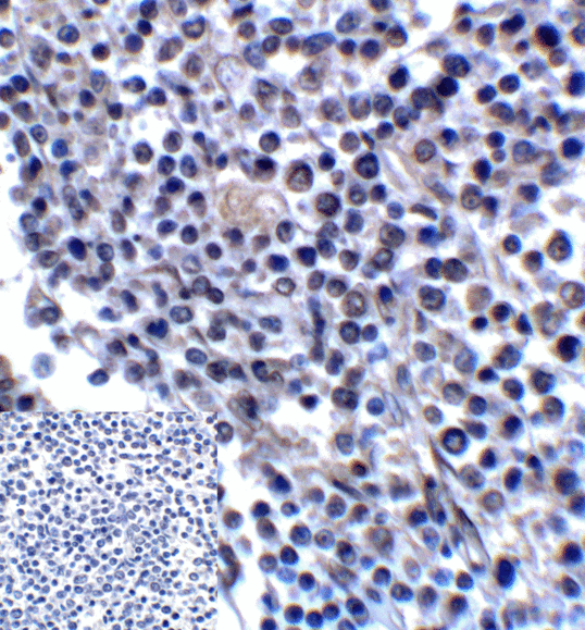 CD276 / B7-H3 Antibody - Immunohistochemistry of B7-H3 in human colon carcinoma tissue using B7-H3 Antibody and control mouse IgG (corner box) at 2 ug/ml.