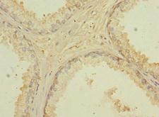 CD276 / B7-H3 Antibody - Immunohistochemistry of paraffin-embedded human prostate cancer at dilution 1:100