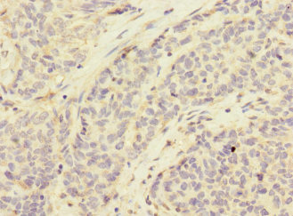 CD276 / B7-H3 Antibody - Immunohistochemistry of paraffin-embedded human ovarian cancer at dilution 1:100