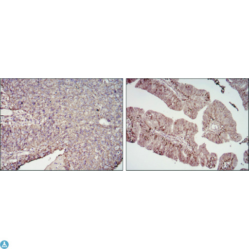 CD276 / B7-H3 Antibody - Immunohistochemistry (IHC) analysis of paraffin-embedded cervical cancer tissues (left) and ovarian cancer tissues (right) with DAB staining using CD276 Monoclonal Antibody.