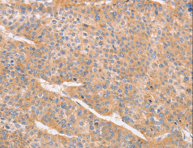 CD2AP Antibody - Immunohistochemistry of paraffin-embedded Human liver cancer using CD2AP Polyclonal Antibody at dilution of 1:70.