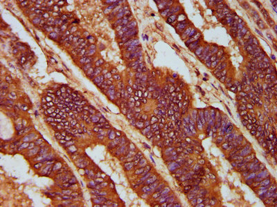 CD2AP Antibody - Immunohistochemistry Dilution at 1:200 and staining in paraffin-embedded human colon cancer performed on a Leica BondTM system. After dewaxing and hydration, antigen retrieval was mediated by high pressure in a citrate buffer (pH 6.0). Section was blocked with 10% normal Goat serum 30min at RT. Then primary antibody (1% BSA) was incubated at 4°C overnight. The primary is detected by a biotinylated Secondary antibody and visualized using an HRP conjugated SP system.
