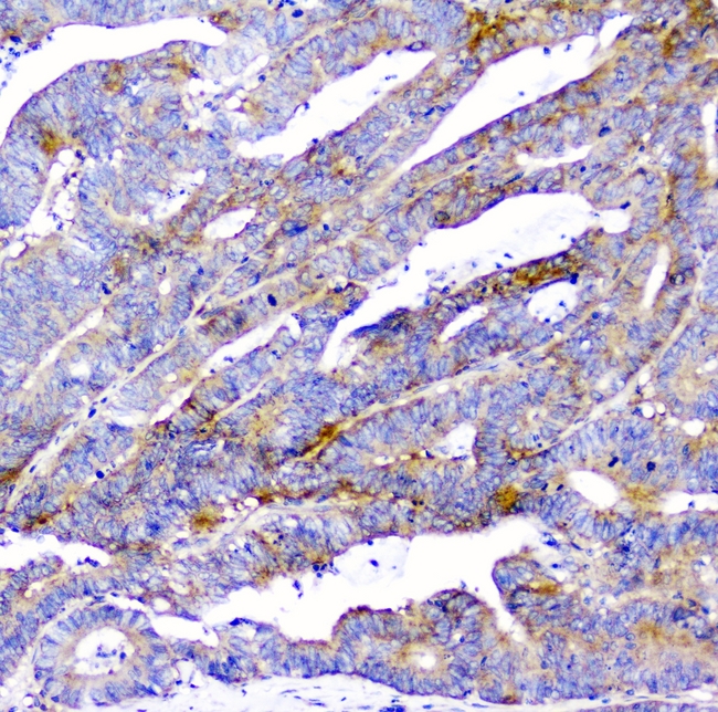 CD2AP Antibody - IHC analysis of CD2AP using anti-CD2AP antibody. CD2AP was detected in paraffin-embedded section of human colon cancer. Heat mediated antigen retrieval was performed in citrate buffer (pH6, epi1ope retrieval solution) for 20 mins. The tissue section was blocked with 10% goat serum. The tissue section was then incubated with 1µg/ml mouse anti-CD2AP Antibody overnight at 4°C. Biotinylated goat anti-mouse IgG was used as secondary antibody and incubated for 30 minutes at 37°C. The tissue section was developed using Strepavidin-Biotin-Complex (SABC) with DAB as the chromogen.