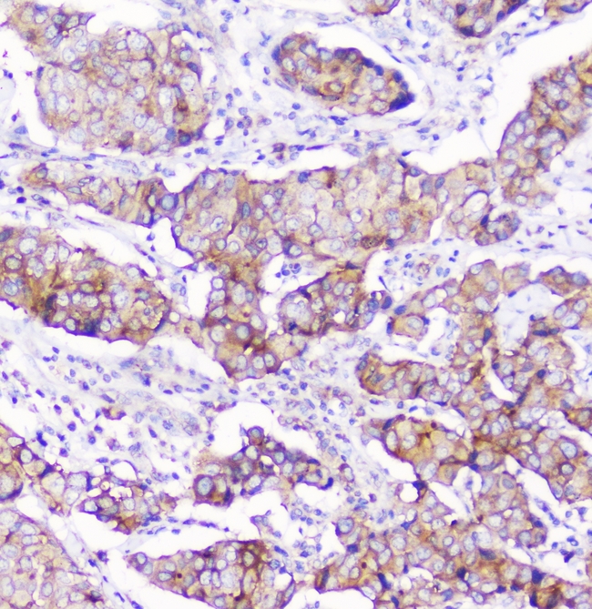 CD2AP Antibody - IHC analysis of CD2AP using anti-CD2AP antibody. CD2AP was detected in paraffin-embedded section of human mammary cancer. Heat mediated antigen retrieval was performed in citrate buffer (pH6, epitope retrieval solution) for 20 mins. The tissue section was blocked with 10% goat serum. The tissue section was then incubated with 1µg/ml mouse anti-CD2AP Antibody overnight at 4°C. Biotinylated goat anti-mouse IgG was used as secondary antibody and incubated for 30 minutes at 37°C. The tissue section was developed using Strepavidin-Biotin-Complex (SABC) with DAB as the chromogen.