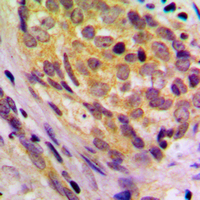 CD2BP2 Antibody - Immunohistochemical analysis of CD2BP2 staining in human breast cancer formalin fixed paraffin embedded tissue section. The section was pre-treated using heat mediated antigen retrieval with sodium citrate buffer (pH 6.0). The section was then incubated with the antibody at room temperature and detected using an HRP conjugated compact polymer system. DAB was used as the chromogen. The section was then counterstained with hematoxylin and mounted with DPX.