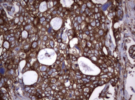 CD30 Antibody - IHC of paraffin-embedded Adenocarcinoma of Human breast tissue using anti-TNFRSF8 mouse monoclonal antibody.