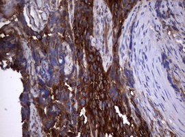 CD30 Antibody - IHC of paraffin-embedded Adenocarcinoma of Human endometrium tissue using anti-TNFRSF8 mouse monoclonal antibody.