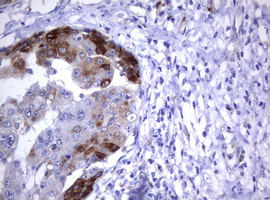 CD30 Antibody - IHC of paraffin-embedded Carcinoma of Human liver tissue using anti-TNFRSF8 mouse monoclonal antibody.