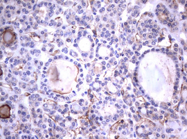 CD30 Antibody - IHC of paraffin-embedded Carcinoma of Human thyroid tissue using anti-TNFRSF8 mouse monoclonal antibody.